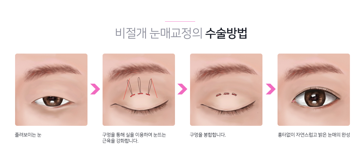청담이지 비절개 눈매교정의 수술방법
