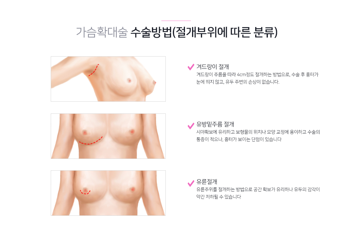 가슴확대술 수술방법, 절개부위에 따른 분류, 겨드랑이 절개, 유방 밑 주름 절개, 유륜절개