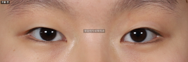 절개쌍꺼풀+눈매교정