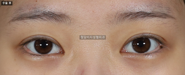 비절개 눈매교정
