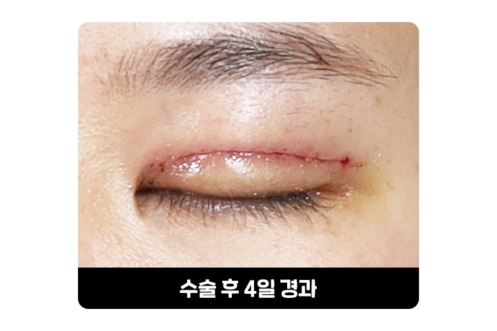 쌍꺼풀 흉터는 많이 남나요? 절개 쌍꺼풀 흉터의 회복 과정