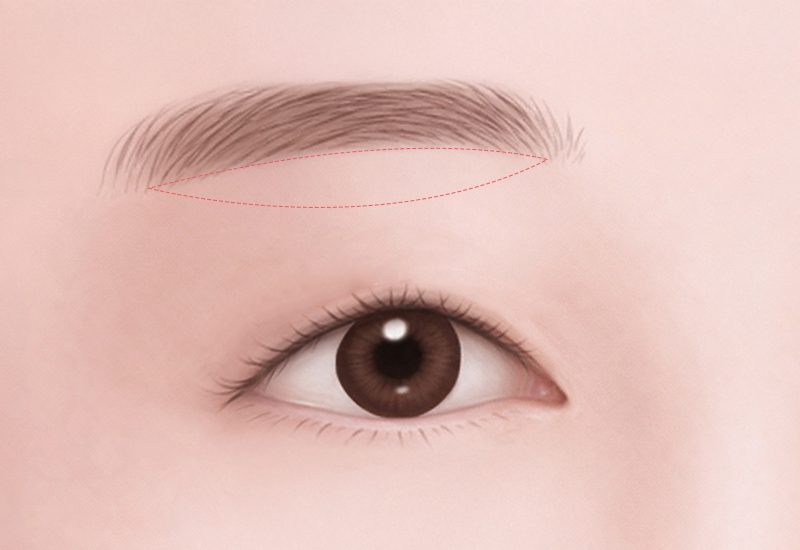 눈썹 아래 절개 일러스트