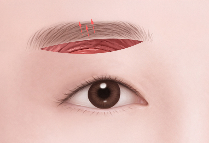 프레쉬 나노 캐뉼라 이미지